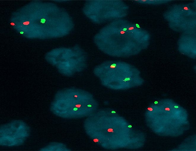熒光原位雜交(FISH)技術在臨床中的應用