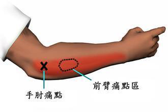 網(wǎng)球肘治療三步曲